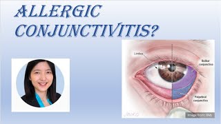 Dr Ding  Allergic Conjunctivitis [upl. by Alehtse]