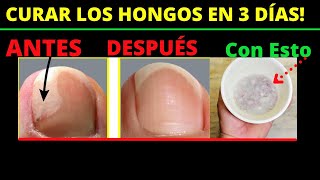 CURAR HONGOS en las Uñas de los Pies en 3 Dias por menos de 2 ¿TIENES HONGOS EN LAS UÑAS [upl. by Etnohs]