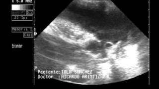 Cardiomiopatia dilatada cmd toracocentesis ecocardiografia caninos [upl. by Atalanti642]