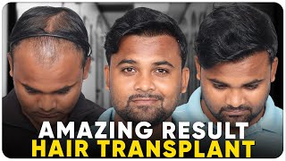 Hair Transplant in Guwahati  Best Results amp Cost of Hair Transplant in Guwahati [upl. by Darooge46]