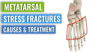 Metatarsal Stress Fractures  Causes Treatment Prevention [upl. by Colwell]