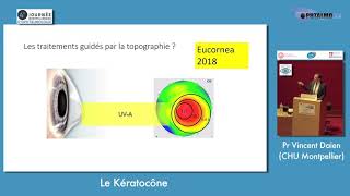 Le kératocône [upl. by Isabel]