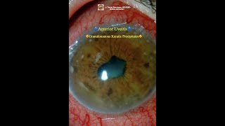 Granulomatous Keratic Precipitates Anterior Uveitis [upl. by Ylrebmyk]