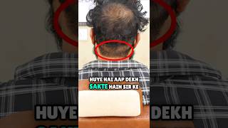 Hair Transplant Gone Wrong😲 [upl. by Ardnaik]