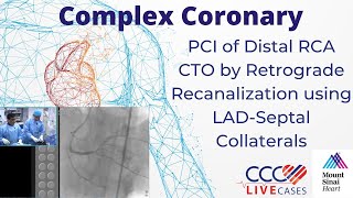 PCI of Distal RCA CTO by Retrograde Recanalization using LADSeptal Collaterals  Sept 2015 Webcast [upl. by Uhp]