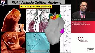 Idiopathic ventricular arrhythmias how to characterize and ablate [upl. by Eeluj302]