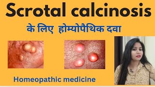 Scrotal calcinosis treatment  Scrotal calcinosis symptomscauses amp homeopathic medicine in hindi [upl. by Finstad]