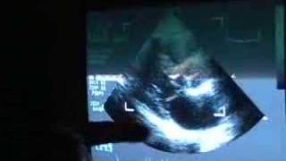 My Echocardiogram [upl. by Tabbitha213]