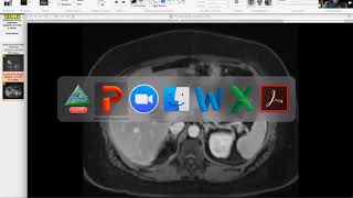 gastric wall thickening w mass by duodenum Victor Sai [upl. by Eico]