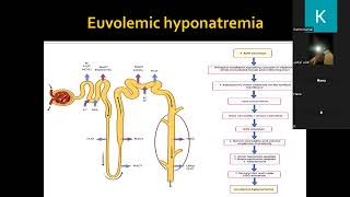 Chronic hyponatremia Dr Kareem Kamal [upl. by Anircam]