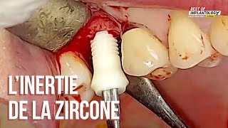 💎 La zircone en implantologie dentaire [upl. by Savart]