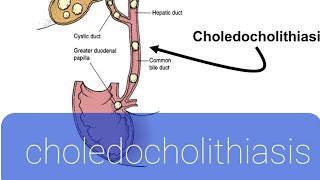 choledocholithiasis [upl. by Olzsal345]