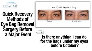 How to Recovery Quickly from Eye Bag Removal Surgery before a Special Occasion [upl. by Zobkiw]