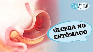 ÚLCERA NO ESTÔMAGO E DUODENO SINTOMAS DIAGNÓSTICO TRATAMENTO E PREVENÇÃO [upl. by Cacka]