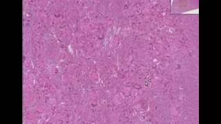 Histopathology Brain ponsArteriovenous malformation [upl. by Alyson]