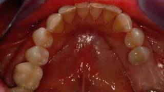 Dental Implant Surgery in a Preserved Site  Singh quotGPSquot Trephine System [upl. by Arretahs]