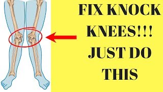 best exercises to correct knock knees [upl. by Pish260]