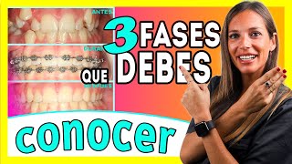 Brackets proceso 𝗠𝗘𝗦 𝗮 𝗠𝗘𝗦 📆 Las ③ 𝐄𝐓𝐀𝐏𝐀𝐒 del TRATAMIENTO de Ortodoncia  Te lo explico ✅ＦÁＣＩＬ [upl. by Lole]