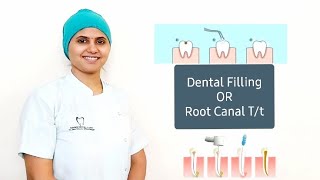 Tooth cavity What to do Tooth Filling or RCT [upl. by Aihtnic158]