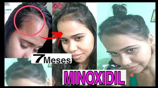 MINOXIDIL  minha experiência quotquase CARECAquot COM FOTOS [upl. by Ainniz]