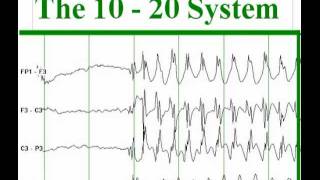 NeuroMyst Pro  Common 1020 EEG Electrode Placements [upl. by Etnod386]