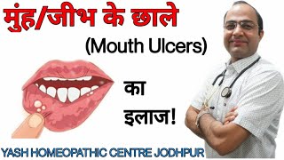 मुँह के छाले का ईलाज । Mouth tongue lips ulcer homeopathic treatment ।best treatment।home remedy [upl. by Galloway]