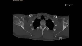 Mediastinal Emphysema  Pneumomediastinum  MedYouCate [upl. by Obmar]