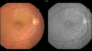 Central Serous Retinopathy Case [upl. by Anyel]