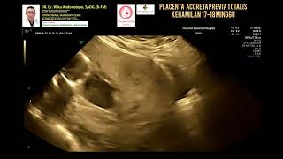 Placenta Accreta Previa Totalis [upl. by Rorke]