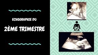 ECHOGRAPHIE DU 2ème TRIMESTRE [upl. by Estrella]