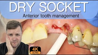 Alveolar Osteitis Management  4K Resolution [upl. by Ardnaik]