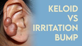 Keloid or Irritation Bump How to fix quotpiercing bumpsquot [upl. by Honeywell]