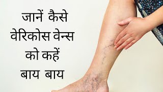 Bye Bye Varicose Veins  वेरिकोस वेन्स को कहें बाय बाय जानें कैसे [upl. by Dani]