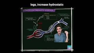 35 Lower Extremity Swelling How does changes in hydrostatic pressure cause lower extremity edema [upl. by Einhpad]