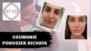 Usuwanie poduszek Bichata na czym polega zabieg jak się go wykonuje OTCO Clinic [upl. by Zawde]