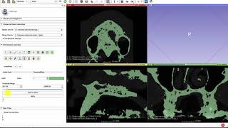 How to make a 3D STL bone model from CBCT DICOM using 3D Slicer for Free DICOM to STL conversion [upl. by Kissee]