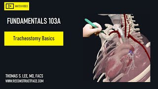 Tracheostomy Basics  ENT perspective  Avoid common complications 103A Didactic [upl. by Merv]