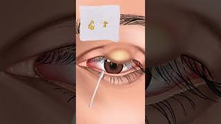 Eye Infection Removal treatment ASMR asmr animation shorts short youtubeshorts youtubeshort [upl. by Pain]