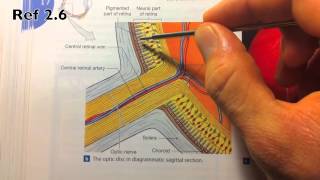 Coloboma of the Retina [upl. by Everara]