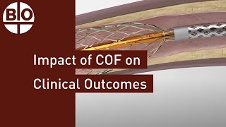 The impact of Chronic Outward Force COF on clinical outcomes [upl. by Inimod210]