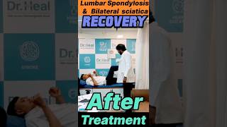 Lumbar Spondylosis amp Bilateral Sciatica Recovery After Treatment yt ad viralvideo reachout [upl. by Aiekam500]