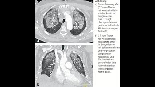 Daptomycin assoziierte eosinophile Pneumonitis [upl. by Seka]