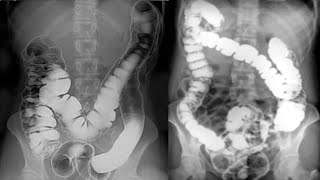 Contrast Examination of GIT  Radiology [upl. by Nnaynaffit410]