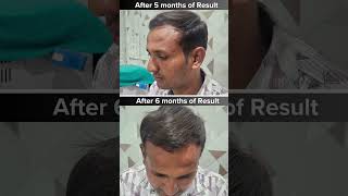 Hair Transplant Result in 9 months beauty haircare hairtransplant hairtreatment [upl. by Ahsiam]