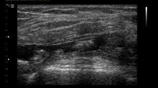 Chronic Synovitis Knee Joint  Effusion Joint  Hypertrophid Synovial [upl. by Nrojb]