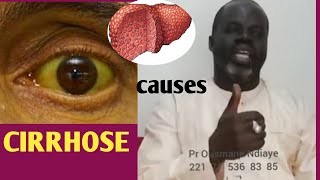 cirrhose causes et symptômes par pr ousmane Ndiaye [upl. by Eleonore]