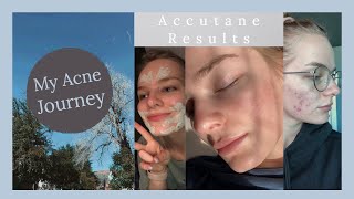 Accutane RESULTS  2040mg LOW DOSE [upl. by Ahsyat592]