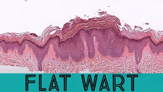 Flat wart under the microscope verruca plana pathology dermpath dermatology dermatopathology [upl. by Ecerahs905]