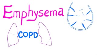 Emphysema  COPD  Pulmonary Medicine [upl. by Oiraved]