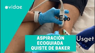 Aspiración ecoguiada de un quiste de Baker por el Dr Ferran Abat [upl. by Yehc]